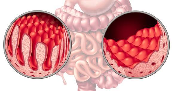 Cos'è la celiachia e che cosa vuol dire essere celiaco